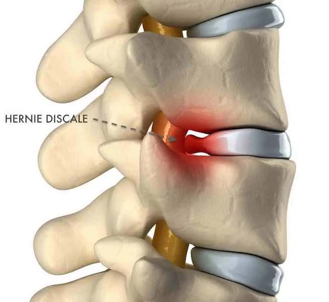 Posture de yoga en torsion - Hernie discale